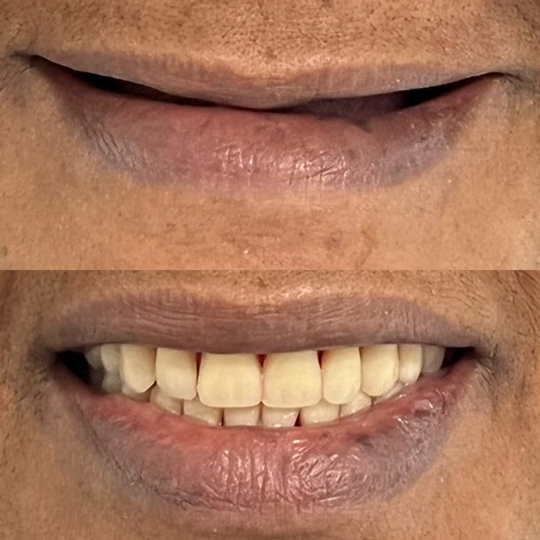 Odontocompany São Lourenço - Antes e Depois - 3v2